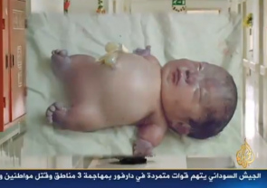 Deformed child
                              in Fallujah by NATO uranium ammunition 01