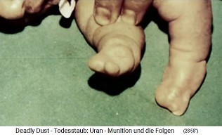 Child with
                                radioactive NATO damage from nuclear
                                missile ("uranium
                                ammunition"), deformed feet