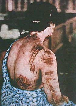 Atombombe Hiroshima: Frau
                          mit eingebranntem Kleidmuster