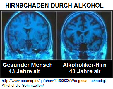 Der Vergleich eines
                    gesunden Gehirns und eines Gehirns eines
                    Alkoholikers mit 43 Jahren - beim Alkoholiker ist
                    das Gehirn nur noch ein Gerippe
