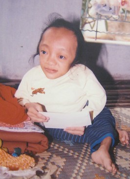 Agent-Orange-Opfer Dao Thi Hoan: Dao Thi Hoan, geboren 1977, aus der Provinz Vinh Phuc