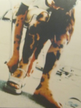 Agent-Orange-Opfer Nguyen Thi Kim Thoa: Nguyen Thi Kim Thoa, geboren 1985, aus der Stadt Thai Binh, Provinz Thai Binh