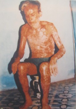 Agent-Orange-Opfer Tran Van Suu: Tran Van Suu, geboren 1937, aus der Gemeinde Phu Thuong, Distrikt Tay Ho, Stadt Hanoi