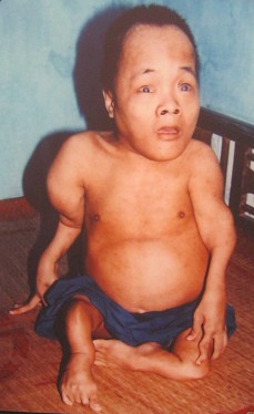 Agent-Orange-Opfer Dang Xam: Dang Xam, aus der Gemeinde Vinh Ha, Distrikt Phu Vang, Provinz Thua Thien Hue