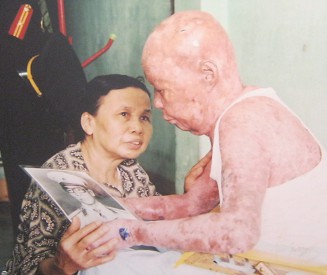 Agent-Orange-Opfer Tu Duc Phang: Tu Duc Phang, 63 Jahre alt, aus dem Stadtbezirk Puhuoc Long, Stadt Nha Trang, Provinz Khanh Hoa Agent-Orange-Opfer Tu Duc Phang: Tu Duc Phang, 63 Jahre alt, aus dem Stadtbezirk Puhuoc Long, Stadt Nha Trang, Provinz Khanh Hoa