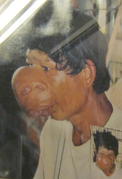 Agent-Orange-Opfer Vo Van Khiem: Vo Van Khiem - geboren 1965, aus dem Distrikt Phu Cat, Provinz Binh Dinh. Seine Krankheit war ein Weichgewebe-Tumor im Gesicht. Foto: Nishimura Yaichi Agent-Orange-Opfer Vo Van Khiem: Vo Van Khiem - geboren 1965, aus dem Distrikt Phu Cat, Provinz Binh Dinh. Seine Krankheit war ein Weichgewebe-Tumor im Gesicht. Foto: Nishimura Yaichi