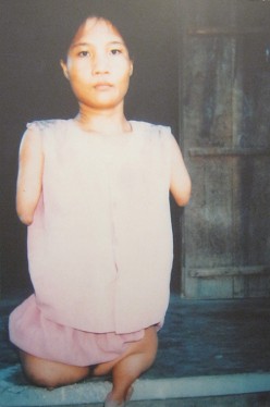 Agent-Orange-Opfer Huynh Thi Thuan: Huyn Thi Thuan, geboren 1977, aus dem Dorf Dai Cat, Gemeinde Minh Phung, Distrikt Ninh Hoa, Provinz Khanh Hoa Agent-Orange-Opfer Huynh Thi Thuan: Huyn Thi Thuan, geboren 1977, aus dem Dorf Dai Cat, Gemeinde Minh Phung, Distrikt Ninh Hoa, Provinz Khanh Hoa