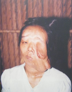 Agent-Orange-Opfer Tran Thi Huong: Tran Thi Huong aus dem Dorf 3, Stadtteil Van Hai, Distrikt Binh Chanh, Saigon (Ho Chi Minh-Stadt) Agent-Orange-Opfer Tran Thi Huong: Tran Thi Huong aus dem Dorf 3, Stadtteil Van Hai, Distrikt Binh Chanh, Saigon (Ho Chi Minh-Stadt)