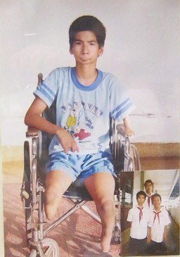Agent-Orange-Opfer Nguyen Minh Phuc: Nguyen Minh Phuc - geboren 1990 - Provinz Tay Ninh. Krankheit: Angeborenes Syndrom mit zusammengezogenen B�ndern [die Unterschenkel sind Stummel, der linke Arm ist ein Stummel, und die rechte Hand hat nur Stummelfinger] Foto: Nishimura Yoichi