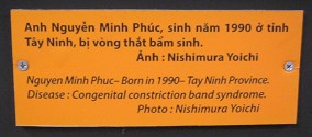 Agent-Orange-Opfer Nguyen Minh Phuc, Text: Nguyen Minh Phuc - geboren 1990 - Provinz Tay Ninh. Krankheit: Angeborenes Syndrom mit zusammengezogenen Bändern Foto: Nishimura Yoichi Agent-Orange-Opfer Nguyen Minh Phuc, Text: Nguyen Minh Phuc - geboren 1990 - Provinz Tay Ninh. Krankheit: Angeborenes Syndrom mit zusammengezogenen Bändern Foto: Nishimura Yoichi