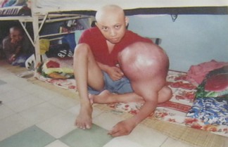 Agent-Orange-Opfer Bui Nhat Quang: Bui Nhat Quang - geboren 1978 - Distrikt Ben Luc, Provinz Long An Krankheit: Lymphangiom (Tumor der Lymphgef�sse) [gigantischer Tumor am linken Arm] Foto: Nishimura Yoichi