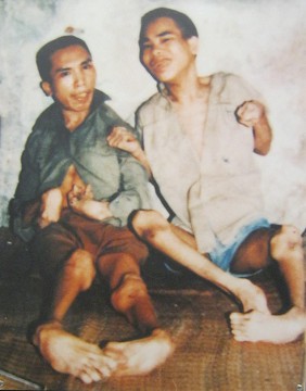 Zwei Agent-Orange-Opfer: Nguyen Van Vuong und Nguyen Van Ba: Nguyen Van Vuong und Nguyen Van Ba aus der Gemeinde Hong Thai, Distrikt Kien Xuong, Provinz Thai Binh [verformte H�nde, Beine und F�sse]