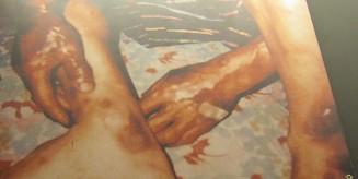 Agent-Orange-Opfer, ein koreanischer Veteran: Der Vietnamkrieg ging zu Ende, aber f�r die Agent-Orange-Opfer ist dieser Krieg nie zu Ende. Hier ein koreanischer Veteran aus dem Vietnamkrieg, auch ein Agent-Orange-Opfer