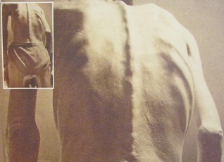 Agent-Orange-Opfer, ein Korea-Veteran:  "Was bin ich? Kein Held, nur ein Krimineller, aber ein Opfer der Geschichte. Der K�rper ist schwer durch Agent Orange gesch�digt." Koreanischer Veteran vom Vietnamkrieg, Agent-Orange-Opfer