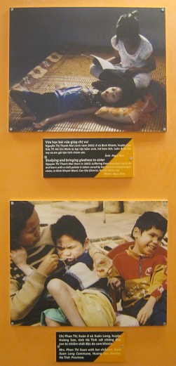 Zwei Agent-Orange-Opfer Zwei Agent-Orange-Opfer