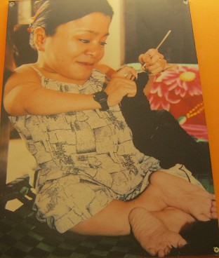 Agent-Orange-Opfer Pham Thi Vuong: Pham Thi Vuong, geboren 1978, aus der Gemeinde Binh Trung, Distrikt Binh Son, Provinz Quang Ngai. Im Alter von 27 ist Vuong nur 80cm gross und wiegt 12kg. Sie wurde mit einer Halbl�hmung geboren, aber sie versucht, eine akademische Bildung zu erreichen, macht Kunsthandwerk und verkauft Sachen. Sie hat Einnahmen, um ihre Familie zu unterst�tzen.