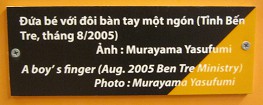 Agent-Orange-Opfer, Text: Die Hand dieses Jungen hat nur einen Finger (August 2005, Ben Tre Ministry) Foto: Murayama Yasufumi