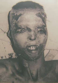 Vietnamkrieg: Phosphorbombenopfer 01