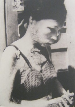 Napalmopfer Nguyen Thi Tu Oanh im Januar 1970: Frau Nguyen Thi Tu Oanh wurde im Januar 1970 durch eine Napalmbombe verwundet - Provinz Quang Binh