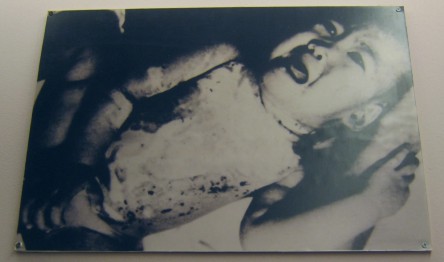 Baby-Napalmopfer Nguyen Hong Tam, 2 Jahre alt, 15. Oktober 1965: Die 2 Jahre alte Nguyen Hong Tam erlitt am 15. Oktober 1965 Brandverletzungen durch Napalmbomben.