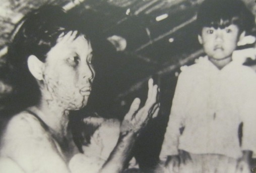 Phosphorbombenopfer Frau Nguyen Thi Ut, neben ihr ihr Sohn: Beide, Frau Nguyen Thi Ut und ihr Kind, wurden durch Phosphorbomben verwundet.