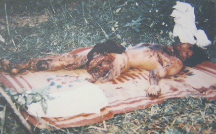 Das hist Ho Van Dang aus dem Weiler Khe Song, Dorf Huong Hiep, Distrikt Da Kong, Provinz Quang Tri [zentrales Vietnam], wurde am 6. November 2003 Opfer einer nicht explodierten "US"-Mine.