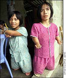 Opfer von Agent Orange mit verst�mmelten H�nden und
                Beinen