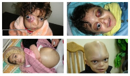 Meldungen über die
                                  kriminell-radioaktive NATO: Im Irak
                                  leben inzwischen haufenweise
                                  deformierte Kinder durch die
                                  radioaktive NATO-Uranmunition