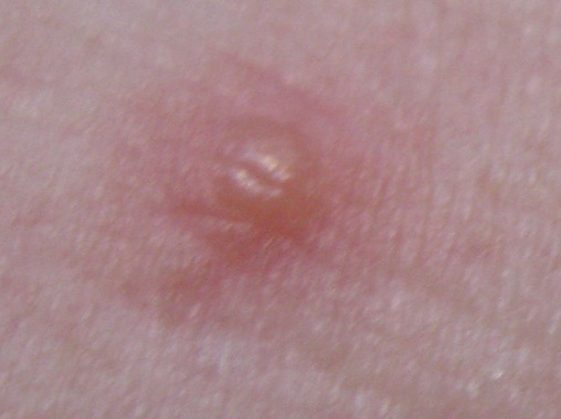 Ein Stich entwickelt eine Blase [16.9.2025 02]