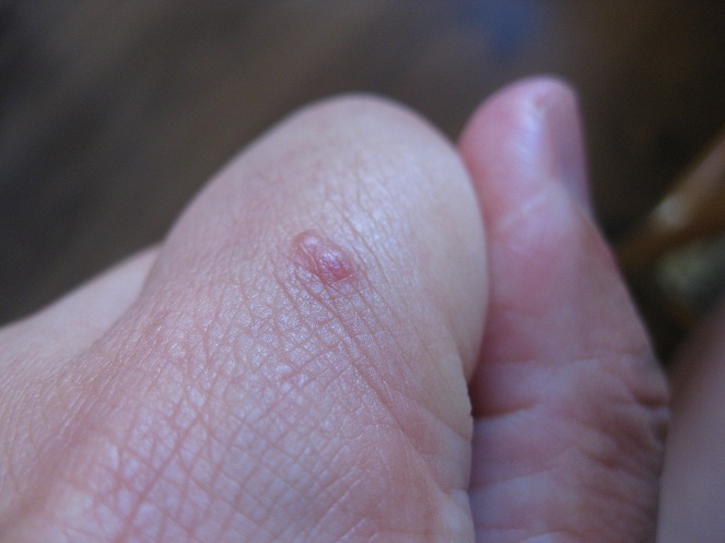 Ein Stich entwickelt eine Blase
                  am linken Zeigefinger 02