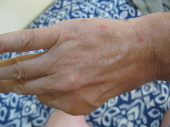 Stiche an der
                  rechten Hand