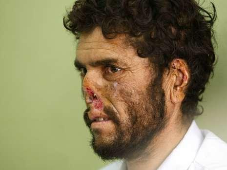 Afghanischer Bauer ohne Nase: Eine radikale
                        Taliban-Gruppe schnitt ihm die Nase ab, weil er
                        im Sinne des westlichen
                        "Demokratie-Systems" der
                        "USA" wählen gehen wollte [3]