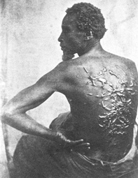 Narben auf dem
              Rücken eines Sklaven in Louisiana
