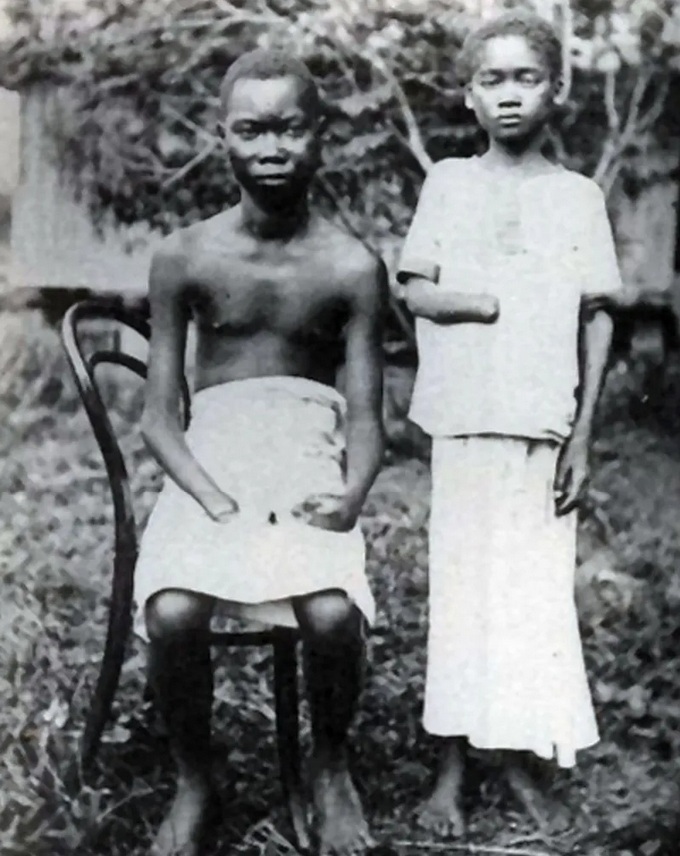 Congo: 2 children without
right hand, amputaded by
criminal "Christian"
colonial forces of Belgium Congo: 2 children without
right hand, amputaded by
criminal "Christian"
colonial forces of Belgium